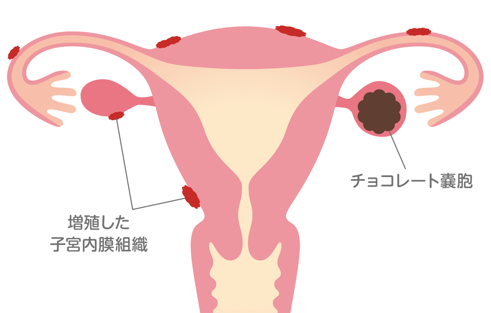 生理 前 子宮 チクチク