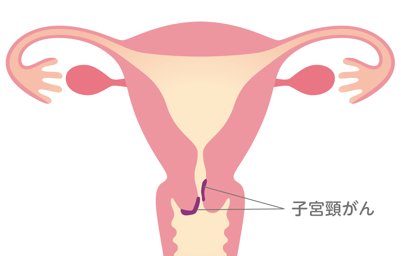 子宮頸がん