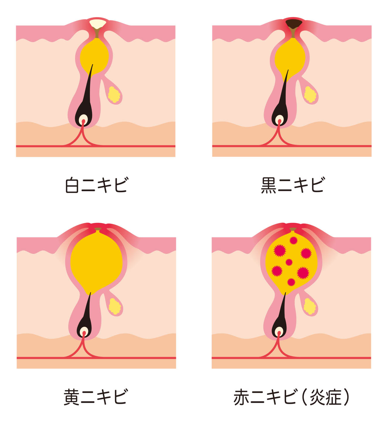 つぶすのは最悪 プツっと目立つニキビ 対処方法3つ 漢方ビュー通信 Kampo View