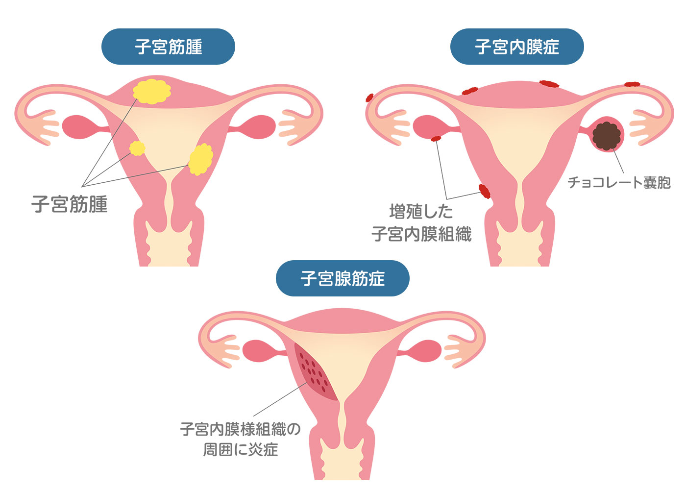 ３０代になったら気を付けたい月経痛３大要因