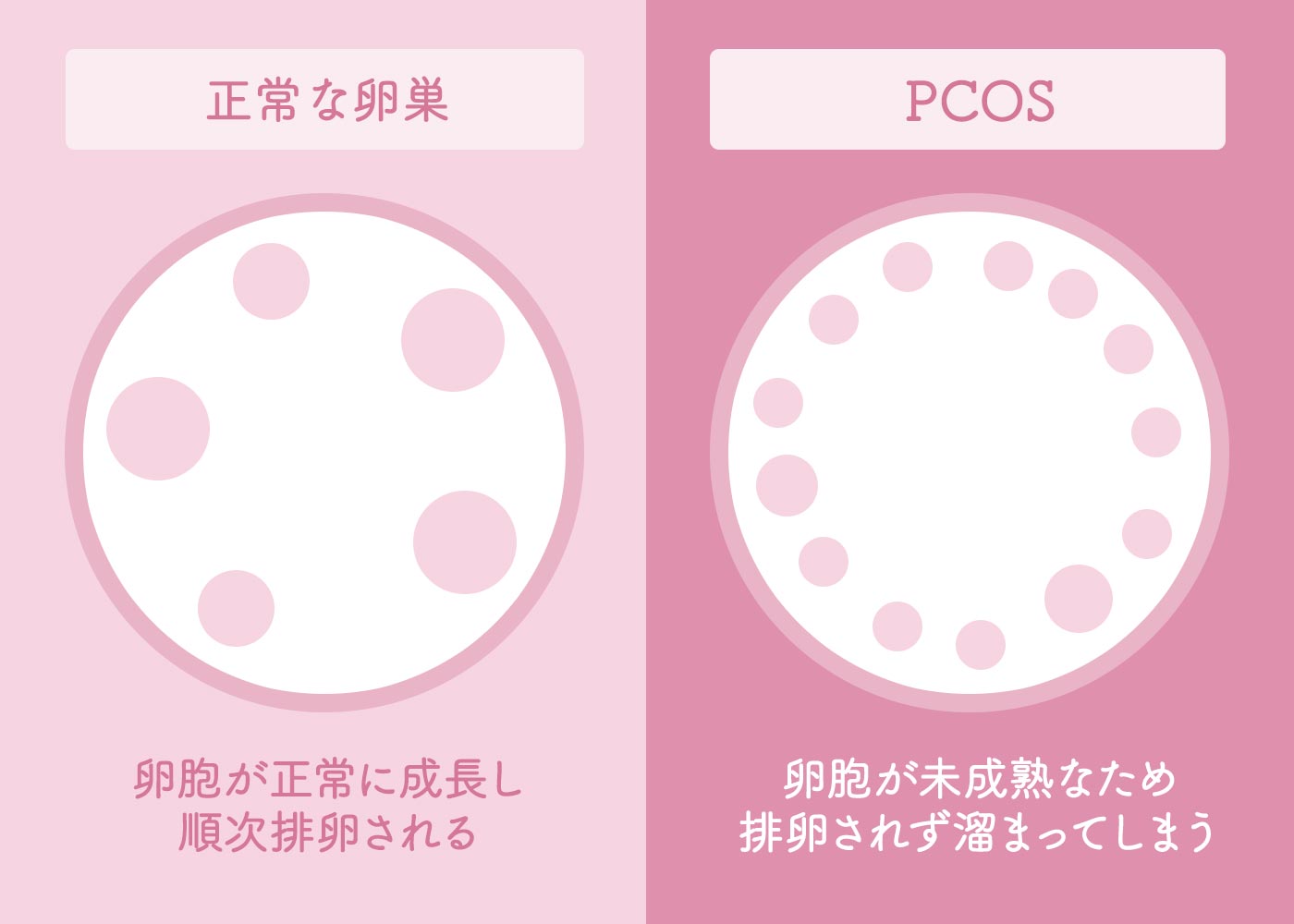 多嚢胞性卵巣症候群 できること