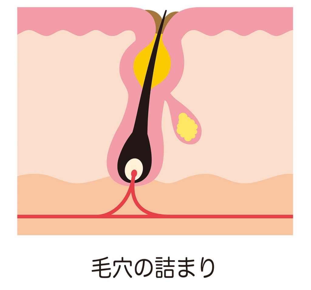 背中ニキビが慢性化しやすい理由