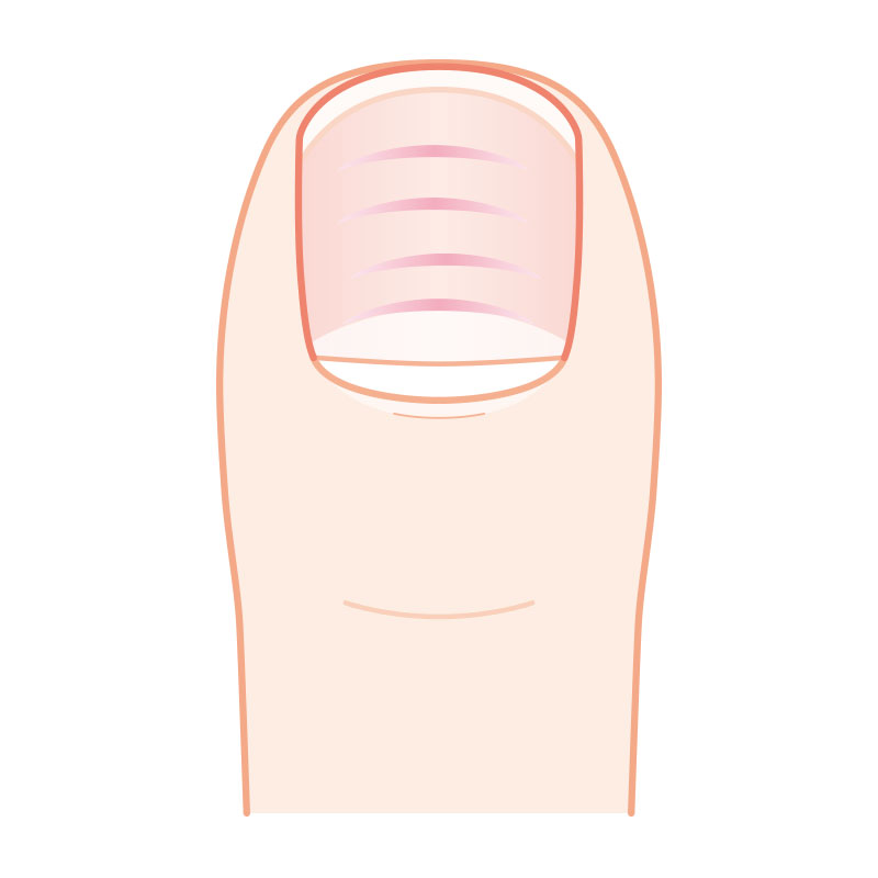 爪に横線が入る