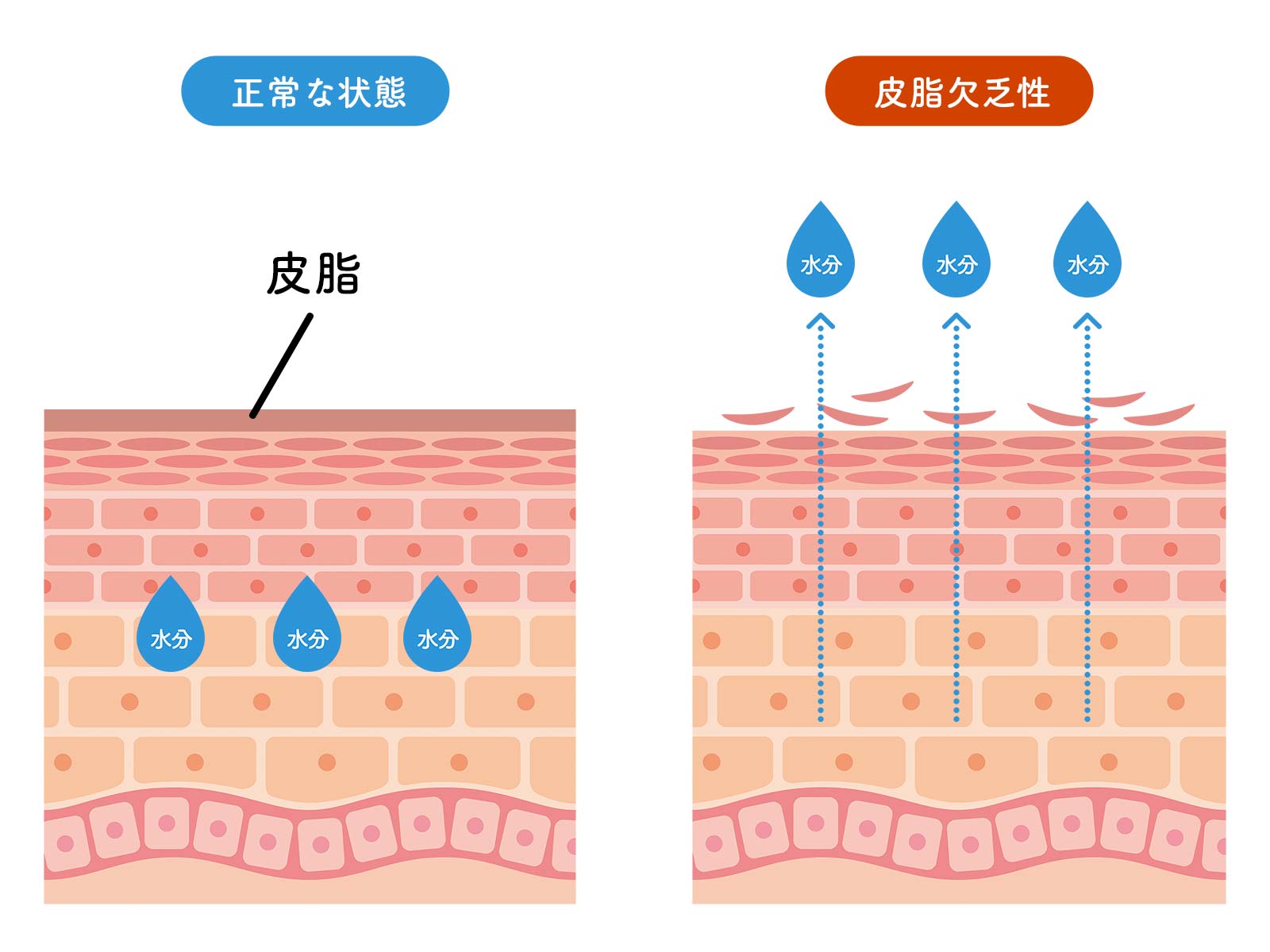 皮脂欠乏性