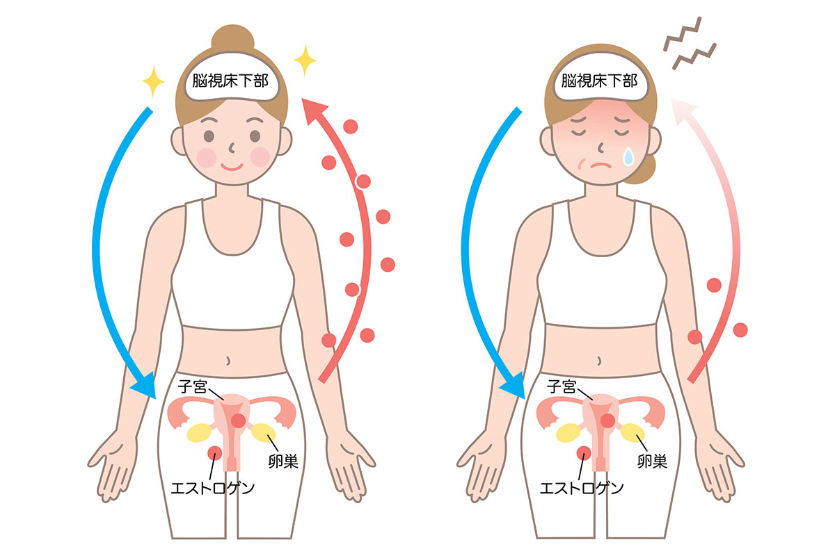 更年期障害はホルモンバランスの乱れが原因